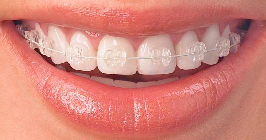 Clear Braces