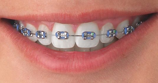 Coloured Braces