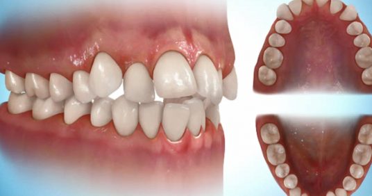 Common Orthodontic Problems